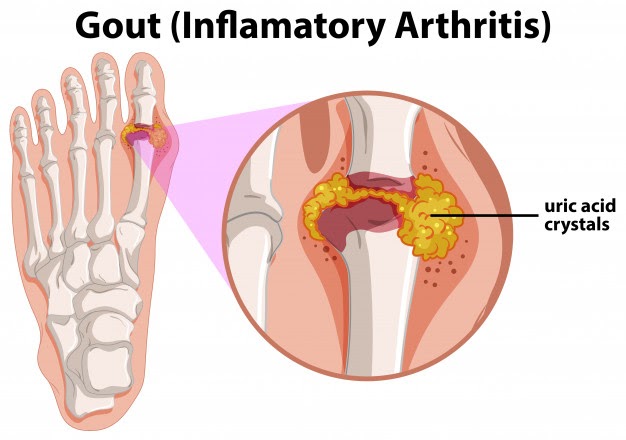 Gouty Arthritis - inflamatory arthritis ayurveda treatment